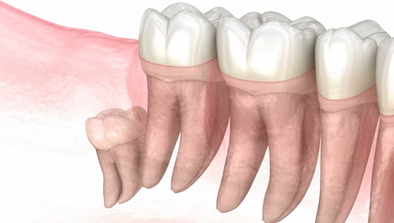 Patient receiving wisdom tooth extraction at a modern dental office