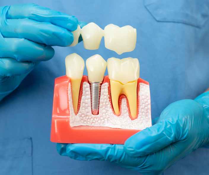 Dental crown restoration on a tooth