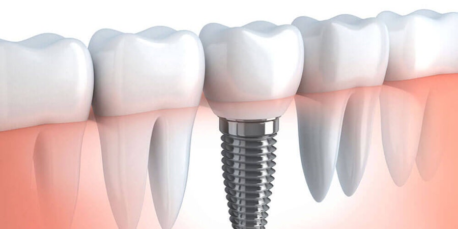 Dental Implants St. Albert