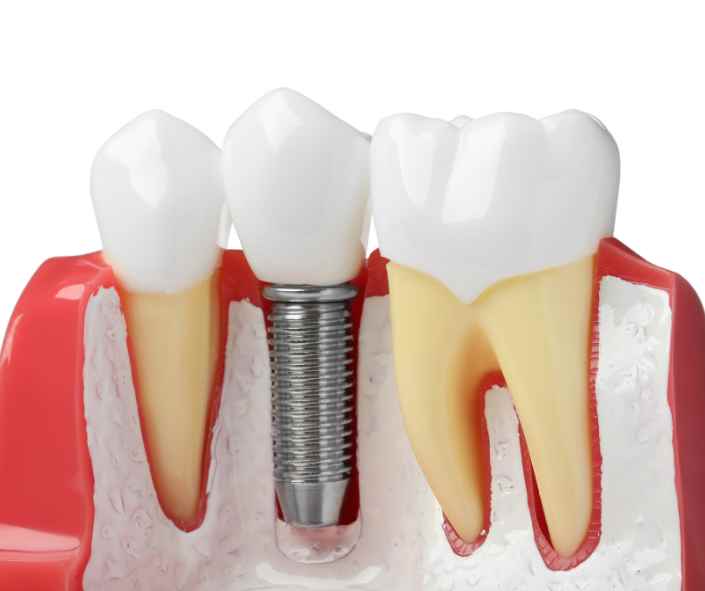 Dental implant procedure illustration