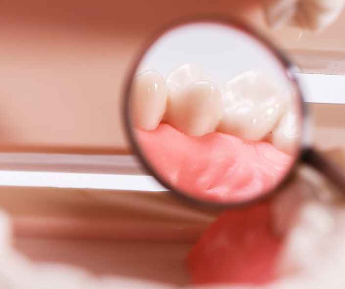 Tooth receiving a composite filling