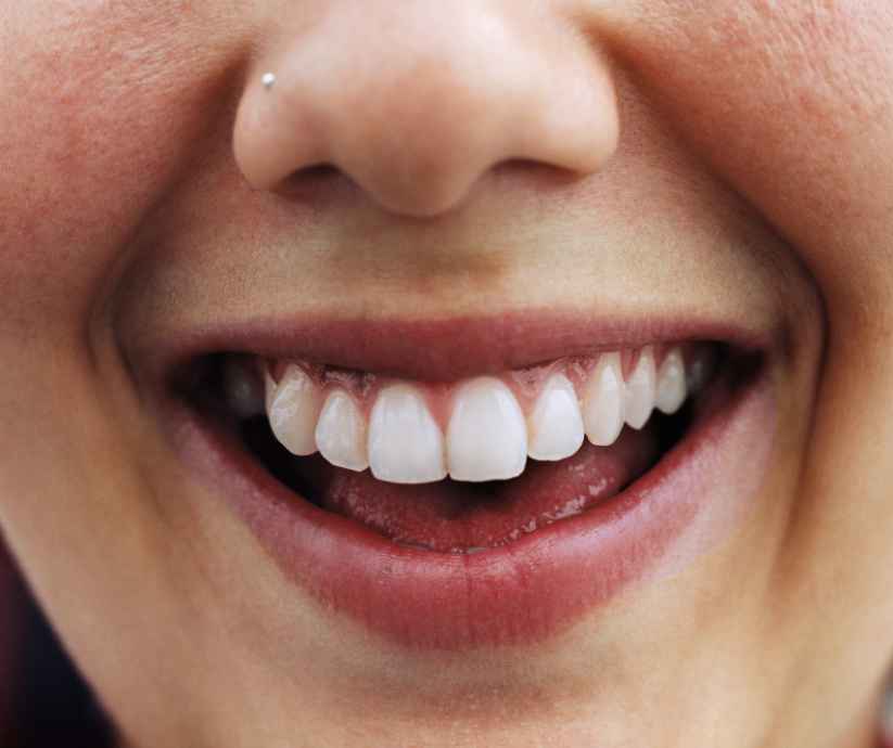 Dentist performing composite bonding on a patient's tooth